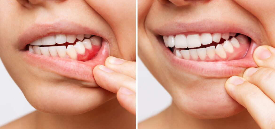 side by side tracking the early signs of gum disease