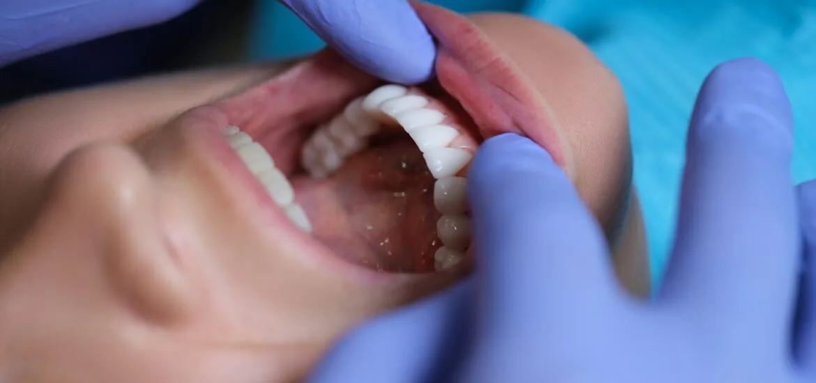 closeup of a dentist examing dental veneers