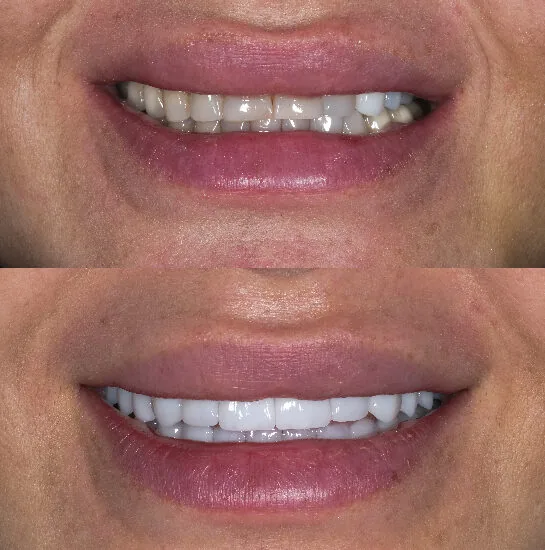 Before and after images showing composite veneers