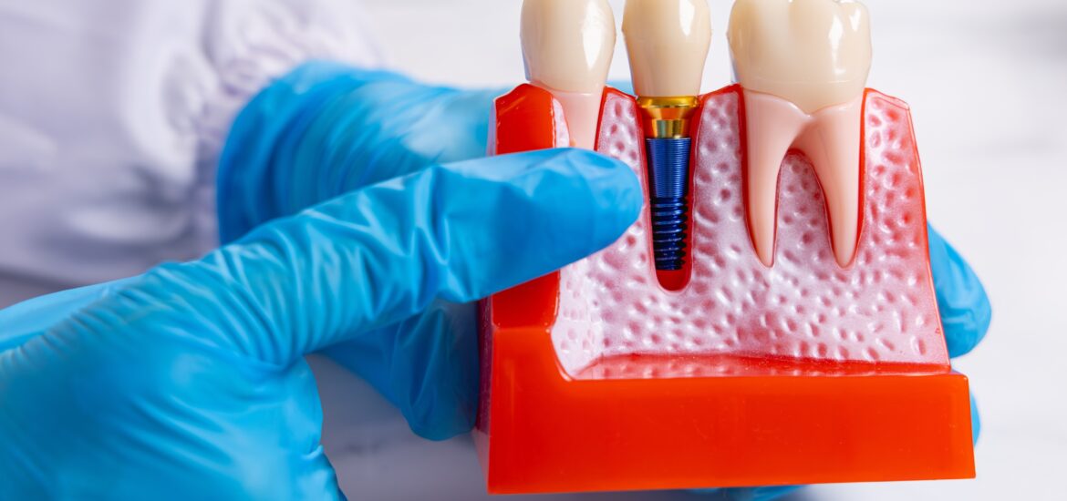 closeup of a dentist in blue gloves pointing at an implant model