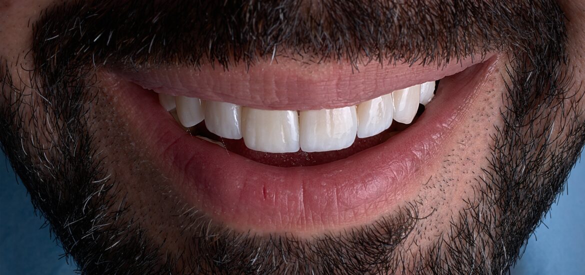 closeup of a restored smile with a dental crown