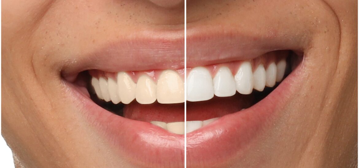 Smiling man before and after teeth whitening treatment, close-up